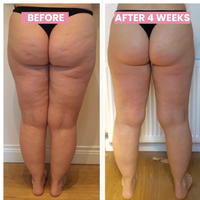 Anticellulite Cupping Apparaat - SlimCupp
