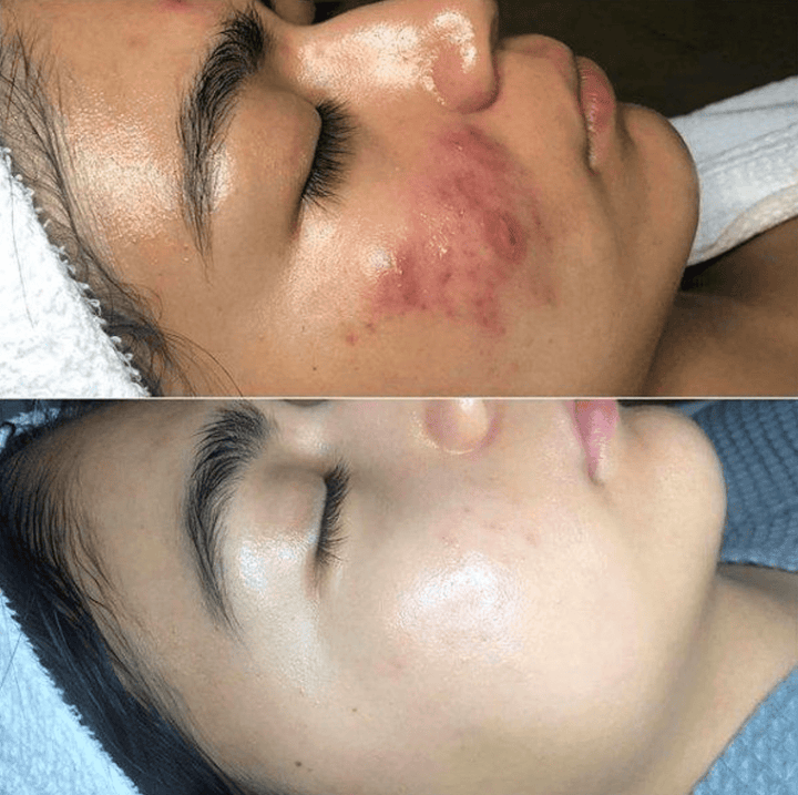 High-Frequency Skin Therapy - GlowWave